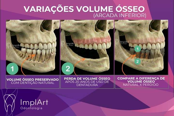 pr&oacute;tese protocolo sem gengiva