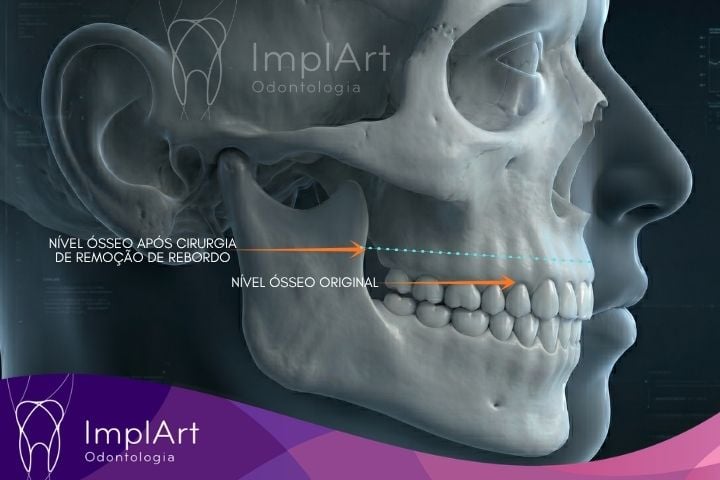 remo&ccedil;&atilde;o de rebordo para protese protocolo em resina sobre implantes dentarios