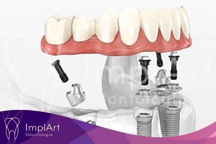 Como é feito o planejamento de implantes dentários na Clínica ImplArt? carga imediata na clinica implart