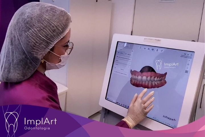 Como é feito o planejamento de implantes dentários na Clínica ImplArt? planejamento digital do sorriso