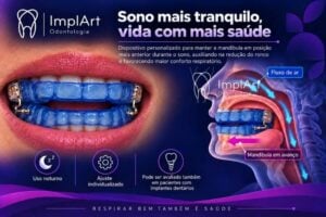 Implante dentário parcial