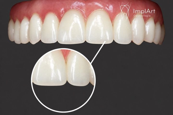 Prótese fixa de zircônia translúcida une beleza e resistência PRÓTESE FIXA DE ZIRCONIA