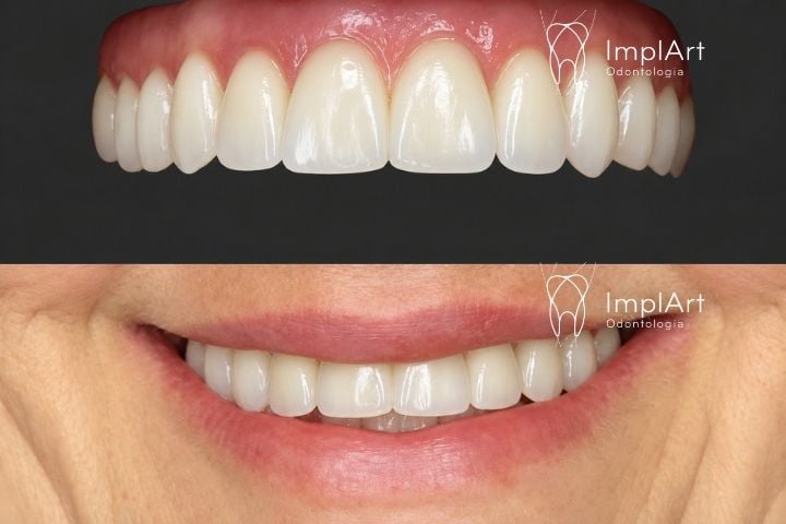 Prótese fixa de zircônia translúcida une beleza e resistência Prótese fixa de zircônia