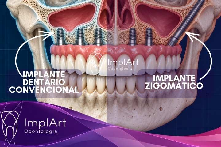 Zygomatic Implant vs. Conventional Implant