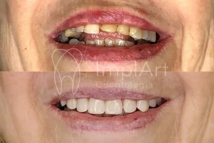 Substitui&ccedil;&atilde;o de dentes