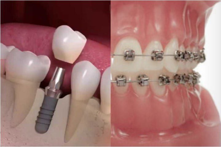 Integração ortodontia e implantes ortodontia e implantes