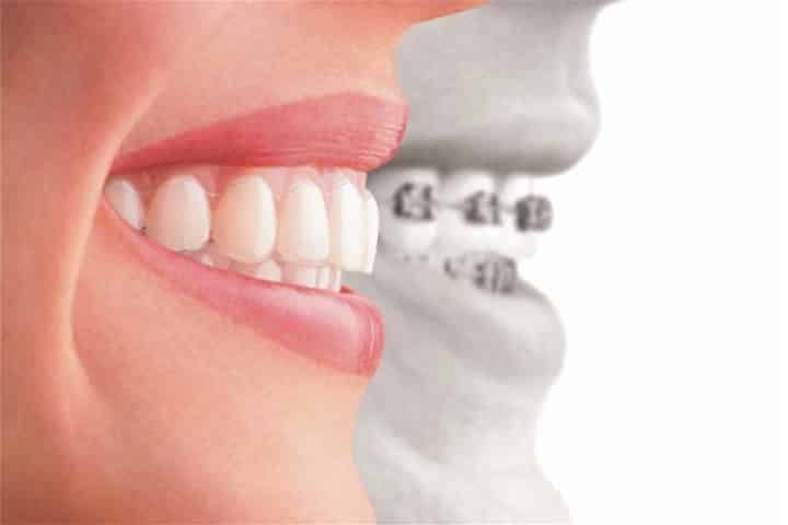 correcting teeth