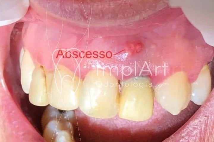 Abscesso dentário é um sinal de infecção bucal abscesso dentário