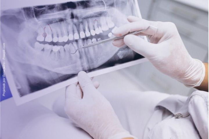 Devo extrair meu dente ou consigo preservar? extrair