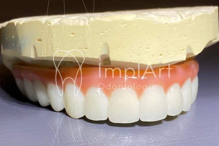 Pr&oacute;tese de zirc&ocirc;nia para implantes