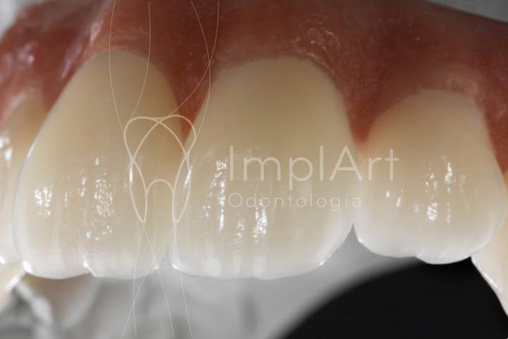 pure zirconia