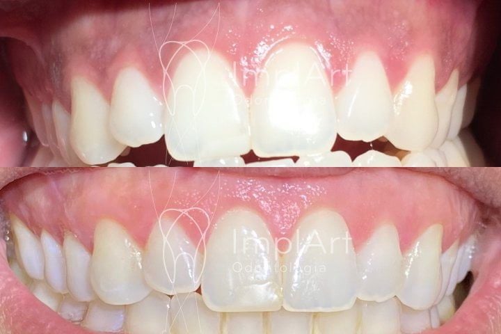 Peeling gengival para tratamento de manchas peeling gengival