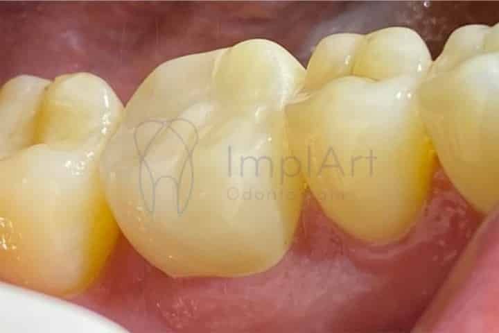 Porcelain crowns