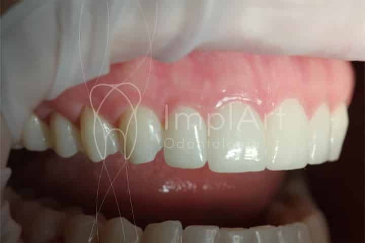Lente de contato dental