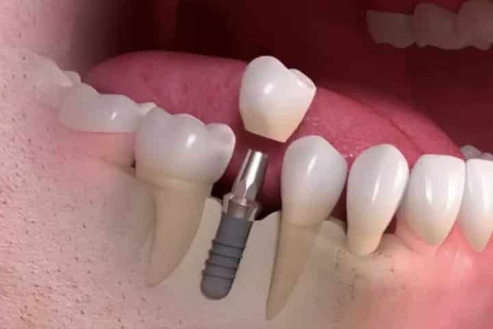 Single tooth dental implant in Brazil DENTAL IMPLANT