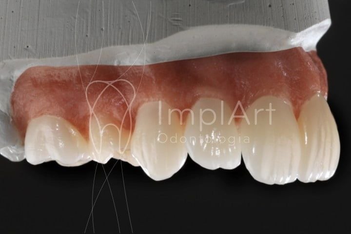 Qual a diferença entre implante dentário e um dente natural? diferenças