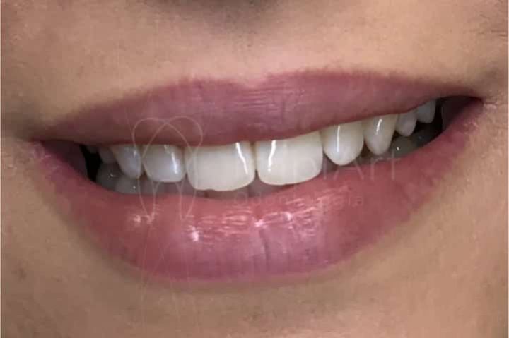 assimetria do sorriso