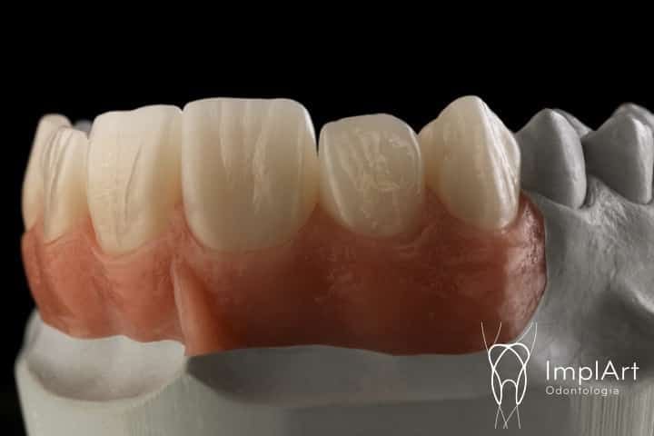 zirc&ocirc;nia dental transl&uacute;cida