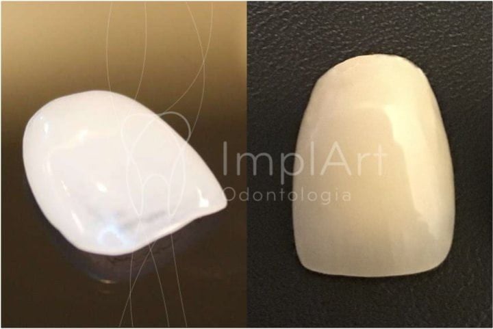 Diferenças entre preparo para lente de contato dental e coroa dentária preparo