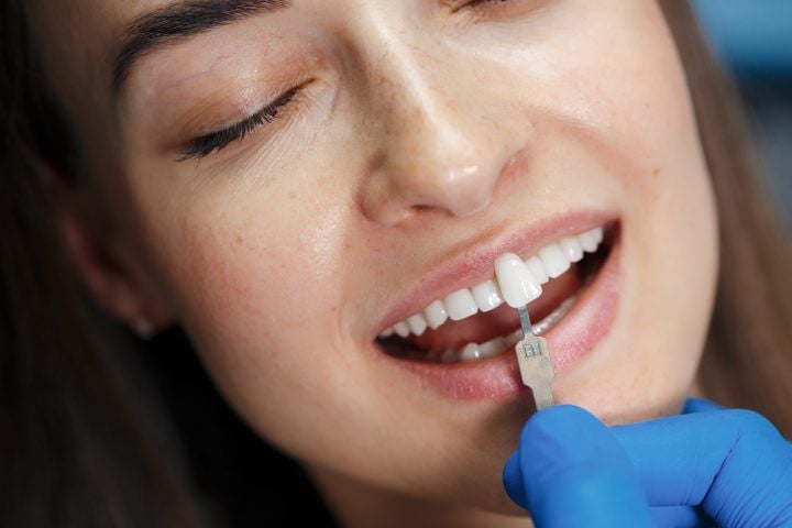 Como é feita a escolha da cor dos dentes na prótese ? cor dos dentes