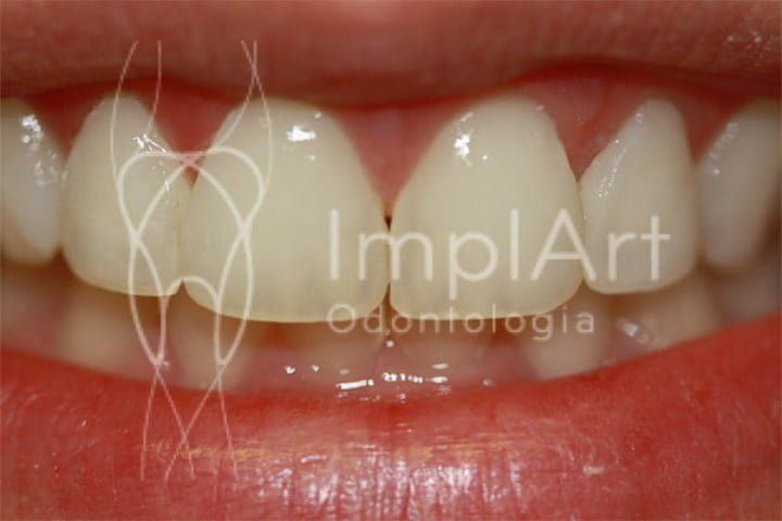 Faceta de resina composta direta Faceta de resina