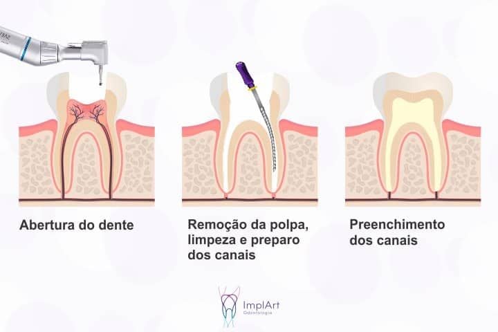 Tratamento de canal