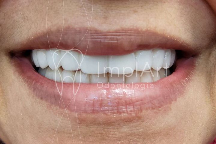 sucesso de um implante dent&aacute;rio