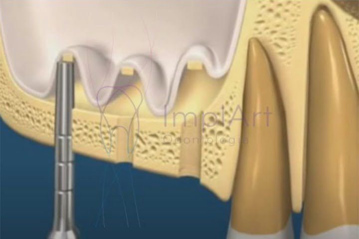 Técnica de Summers e Implante dentário e enxerto ósseo na mesma cirurgia técnica de summers