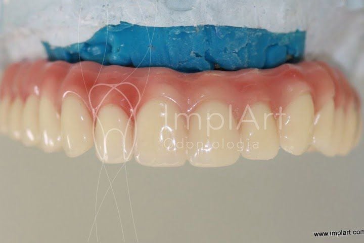 Prótese total em resina sobre implantes com dentes importados ou nacionais: quais escolher? dentes importados