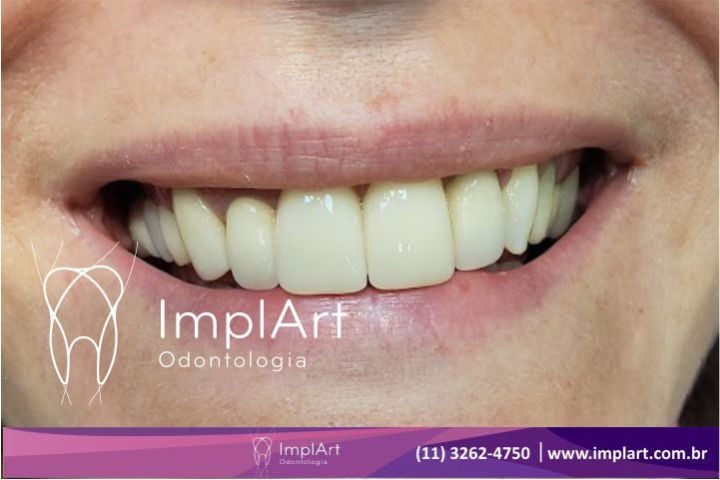 Substituição de coroa metalocerâmica por coroa de zircônia coroa metalocerâmica
