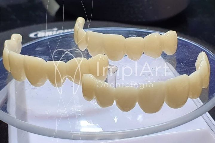 Temporary teeth