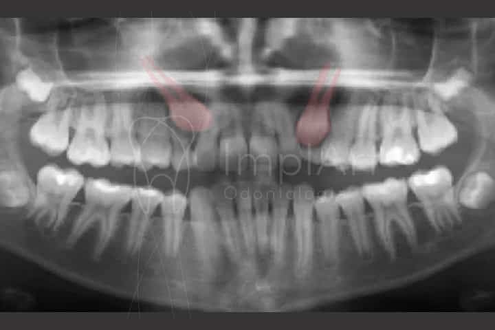 Tratamento ortodôntico de dentes retidos dentes retidos