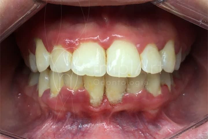 Gengivite: o que é, como evitar e como tratar gengivite