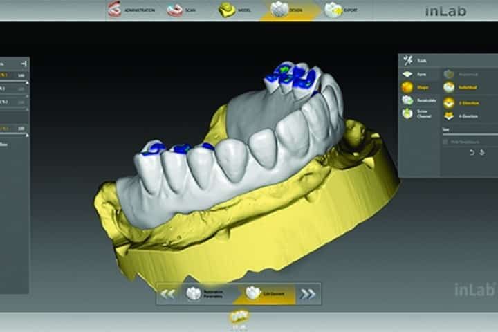 Digital dental design digital prosthesis design