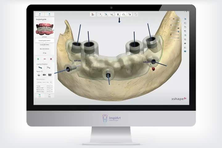 guided implant surgery