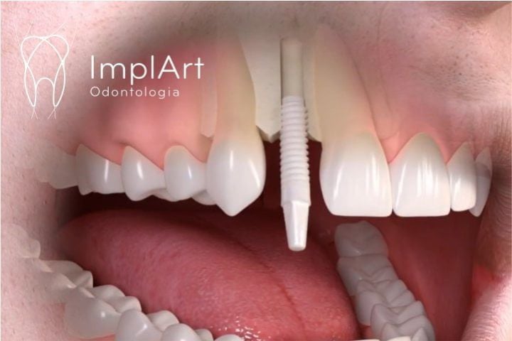 Implante de zircônia: alternativa segura e moderna para substituição de dentes perdidos IMPLANTE DE ZIRCONIA