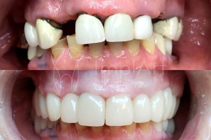Implante dentário nos dentes da frente frente