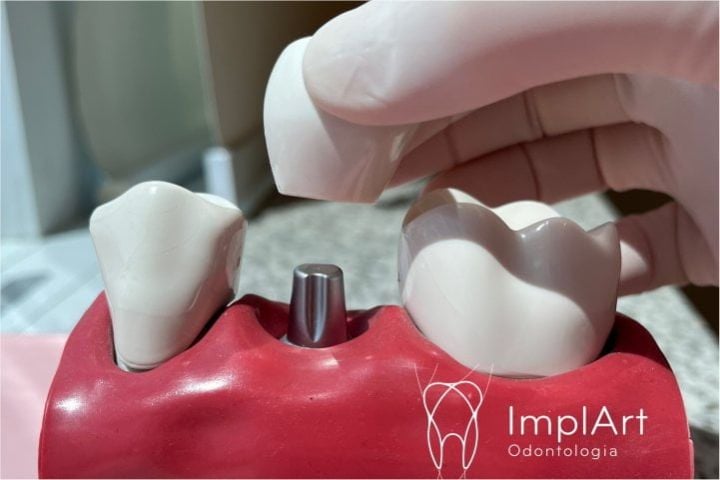 Extrair dente e colocar implante dentário no mesmo dia colocar implante