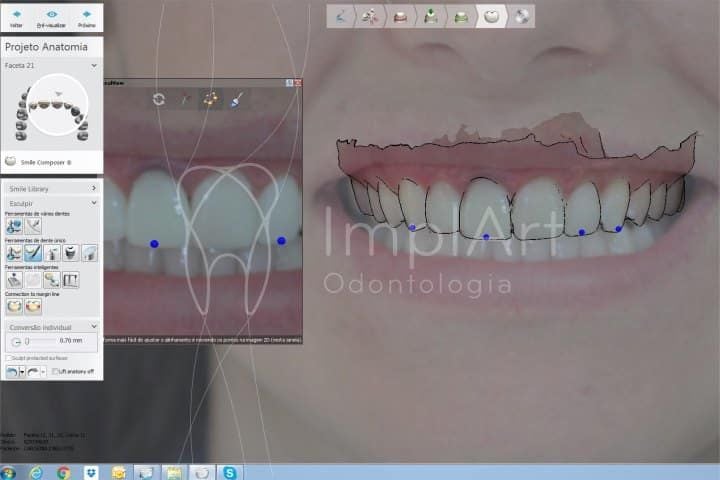 Estética dental computadorizada - planejamento Estética dental computadorizada