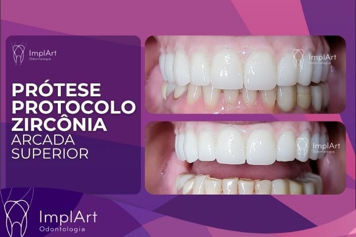 Prótese Protocolo Dentário: O que é, como é fixada, como funciona ? prótese protocolo
