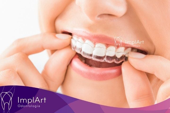INVISALIGN