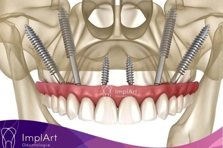 Implante zigomático é uma alternativa ao enxerto ósseo IMPLANTES ZIGOMATICOS