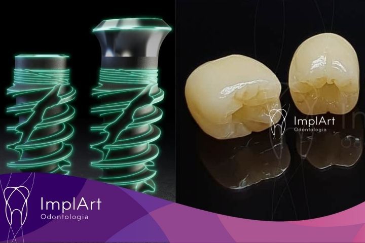 Combinação do Moderno Implante Straumann iEXCEL e Prótese de Zircônia CAD/CAM: Implante Rápido na ImplArt implante straumann iexcel e protese de zirconia