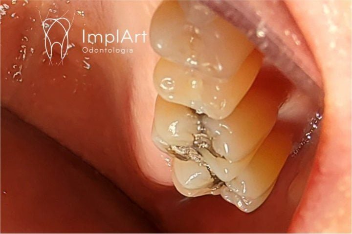 remo&ccedil;&atilde;o segura