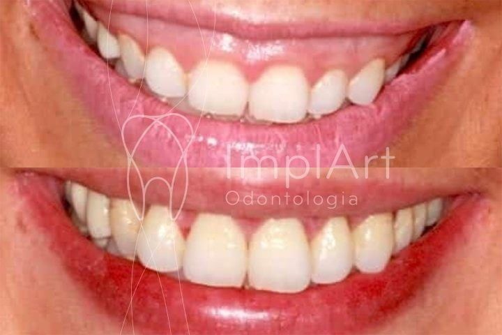 Tratamentos para o sorriso gengival sorriso gengival