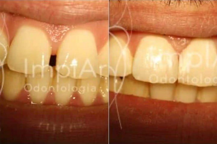 diastema