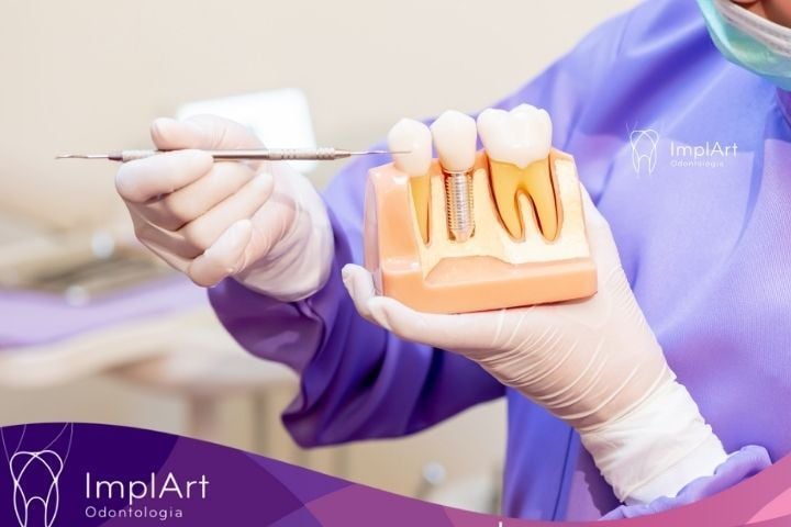 Clínica de Implante Dentário: Etapas do Implante Dentario na Clínica ImplArt ETAPAS DO IMPLANTE DENTARIO