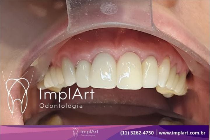 Dente artificial para o dente da frente fica bom? dente artificial