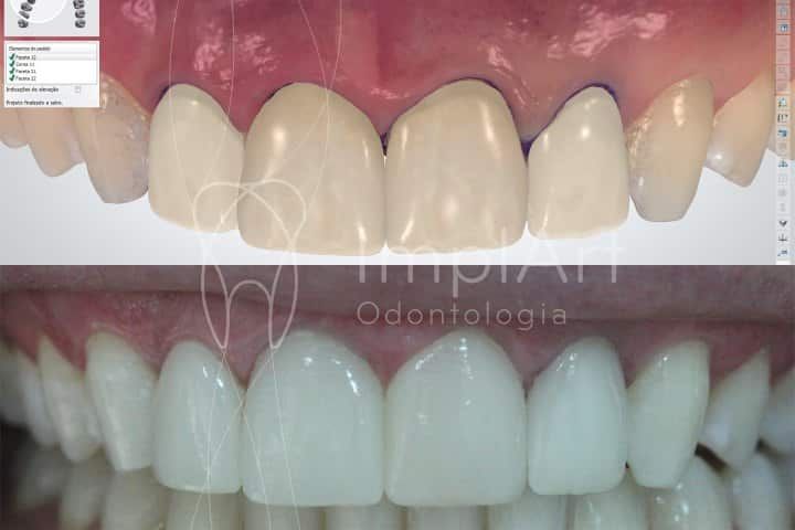 Sorriso projetado