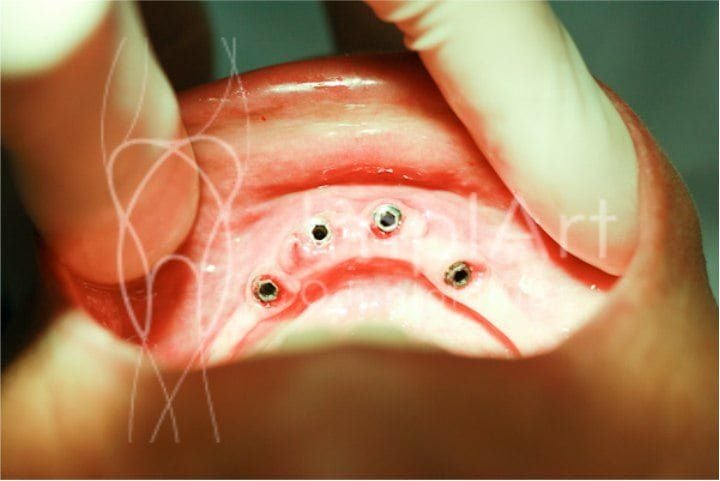 O que é reabertura de implante? reabertura de implante